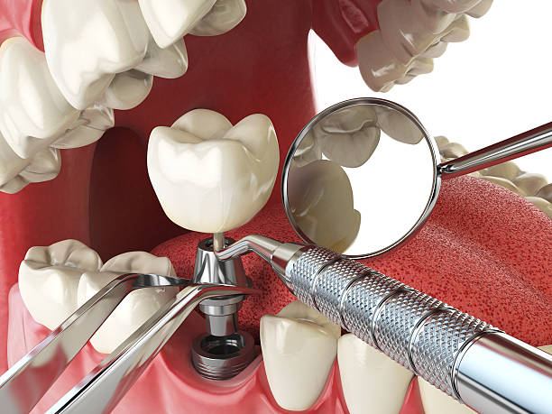 Best Emergency Treatment for Dental Infections or Abscesses in Kingston, NJ